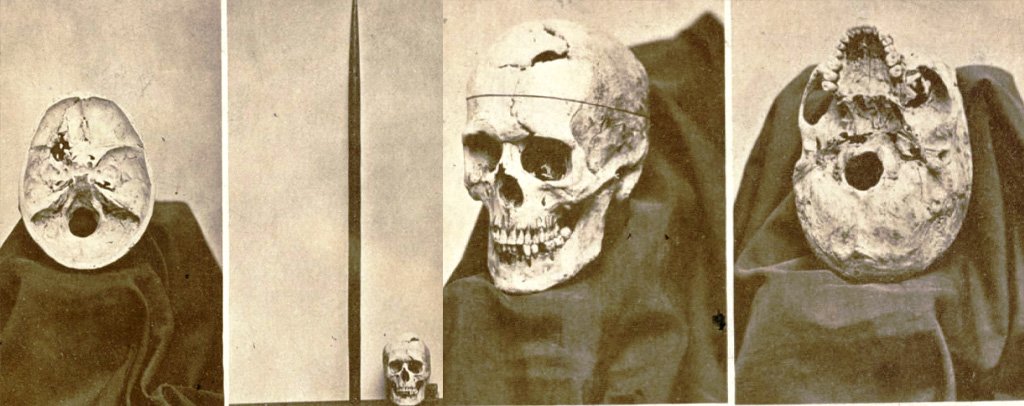 Phineas Gage